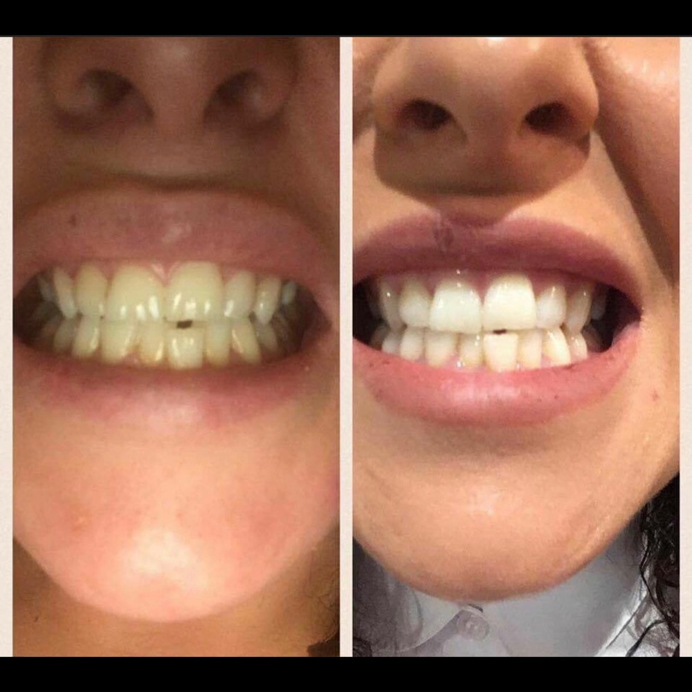 FLUORIDE WHITENING TOOTHPASTE